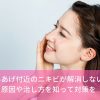 もみあげ付近のニキビが解消しない！原因や治し方を知って対策を